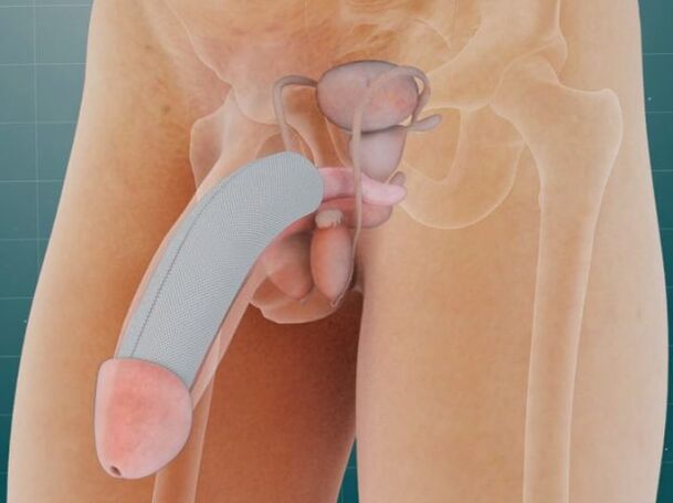The penis after a special implant has been placed under the skin