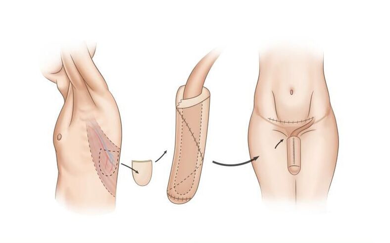 Phalloplasty for penis enlargement